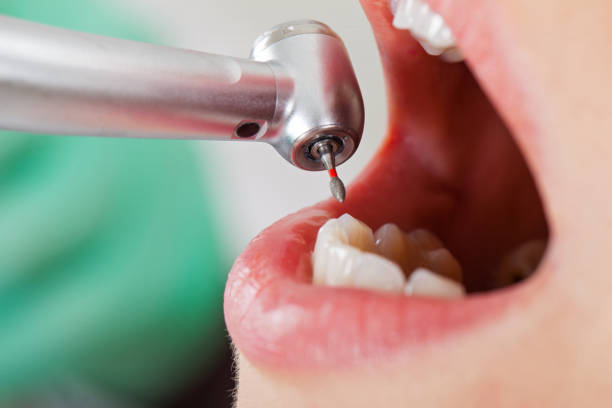 Teeth Whitening in MD
